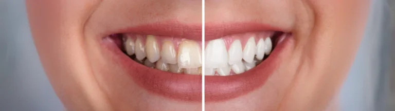 Blanqueamiento Dental Philips Zoom